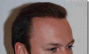 Hair restoration procedure results