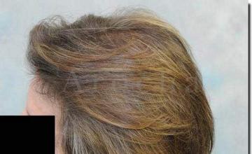 Hair restoration procedure results