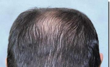 Hair restoration procedure results