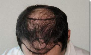 Hair restoration procedure results