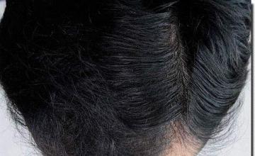 Hair restoration procedure results