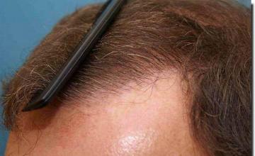 Hair restoration procedure results