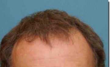 Hair restoration procedure results