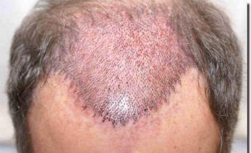 Hair restoration procedure results