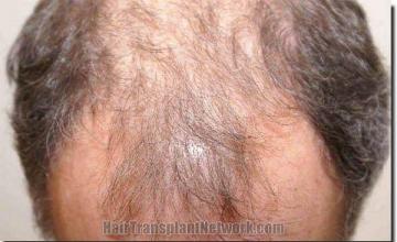 Hair restoration procedure results