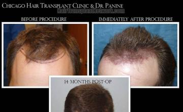 Hair restoration procedure before and after results