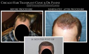 Hair transplantation surgery before and after images