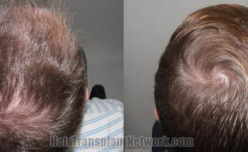 Top view - Before and after surgical hair replacement