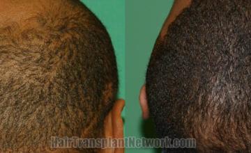 Back view before and after hair transplantation 