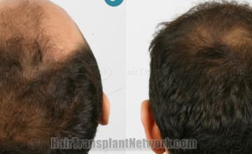 Back view before and after hair transplantation 