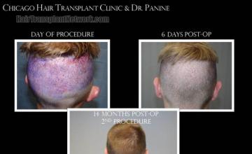 Hair replacement surgery before and after images