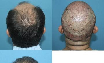 Surgical hair transplantation result photographs