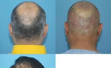 Surgical hair transplantation result photographs