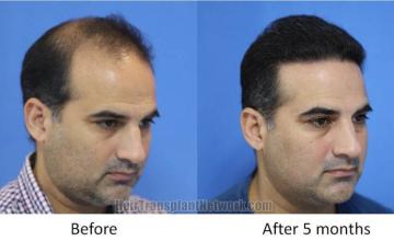 Hair transplantation procedure before and after results