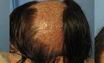 Before and after photos of a burns victims hair transplant