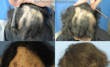 Hair restoration photos of a burn victim before and after