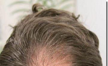 Hair restoration procedure results