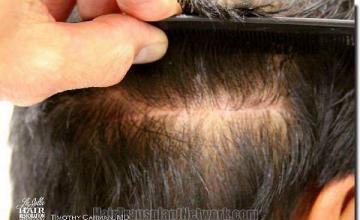 Hair restoration procedure results