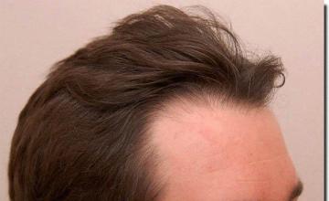 Hair restoration procedure results