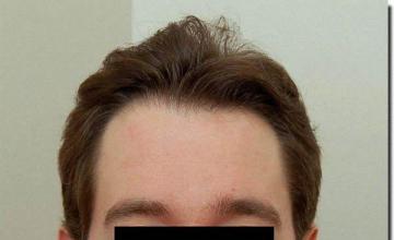 Hair restoration procedure results