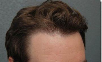 Hair restoration procedure results