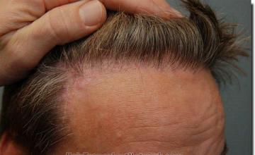 Hair restoration procedure results