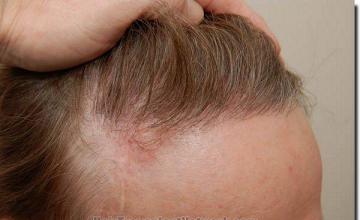 Hair restoration procedure results