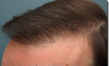 Hair restoration procedure results