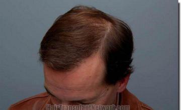 Hair restoration procedure results