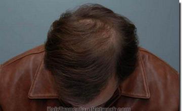 Hair restoration procedure results