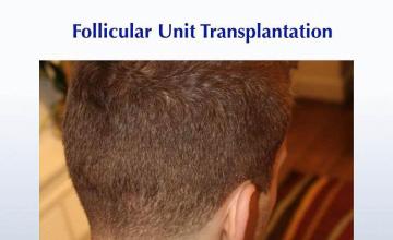 Surgical hair transplantation result photographs