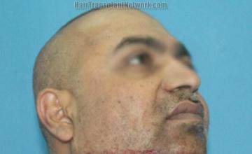 Hair restoration procedure before and after images