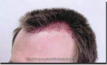 Hair restoration procedure results