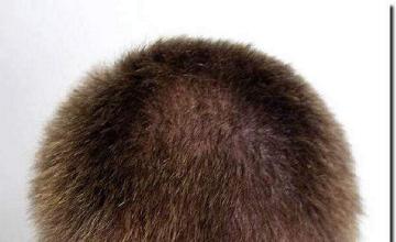 Hair restoration procedure results