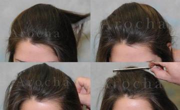 Female hair restoration patient