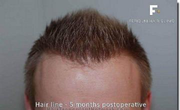 Hair restoration procedure results