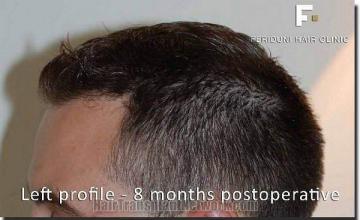 Hair restoration procedure results