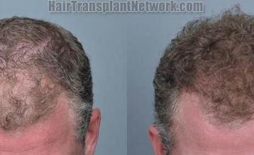 Hair restoration procedure before and after results