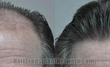 Hair restoration procedure before and after results