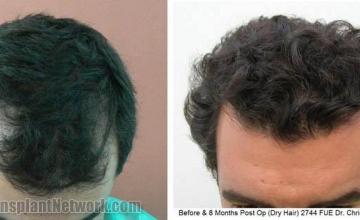 Hair restoration procedure before and after results