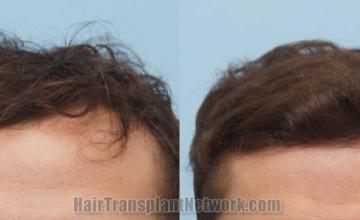 Front view - Before and after