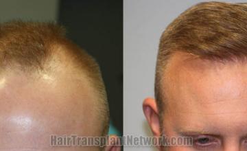   before and after result photographs