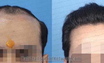 before and after result photographs