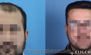 before and after result photographs