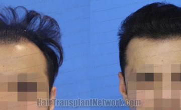   before and after result photographs