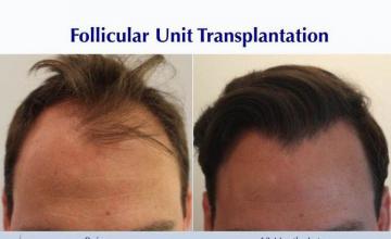 Front view - Before and after hair restoration procedure