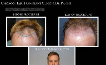 Front view - Before and after hair restoration procedure