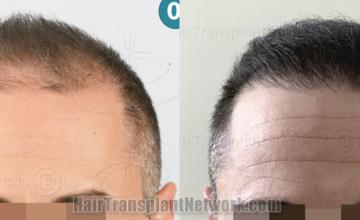   before and after result photographs