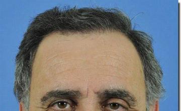 Hair restoration procedure results