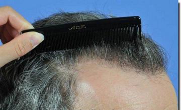 Hair restoration procedure results